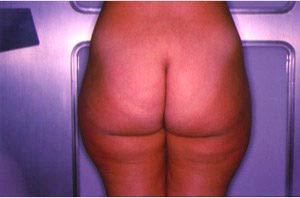 cellulite fibrosclerotica