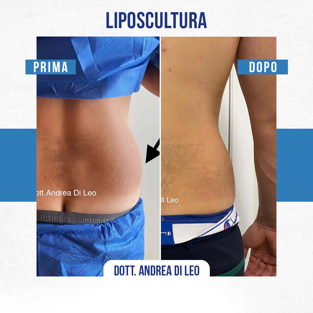 IMG-LIPOSCULTURA-01