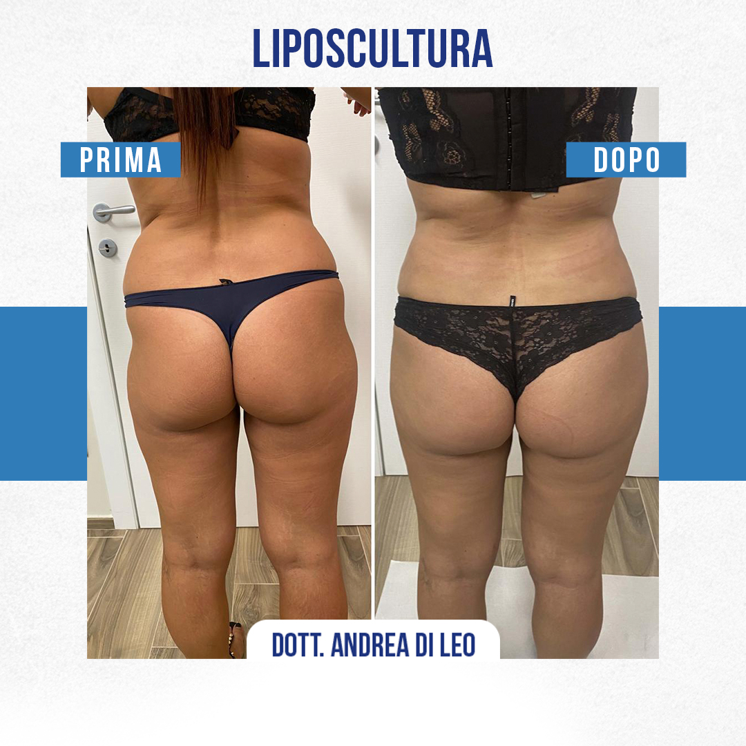 IMG-LIPOSCULTURA-02