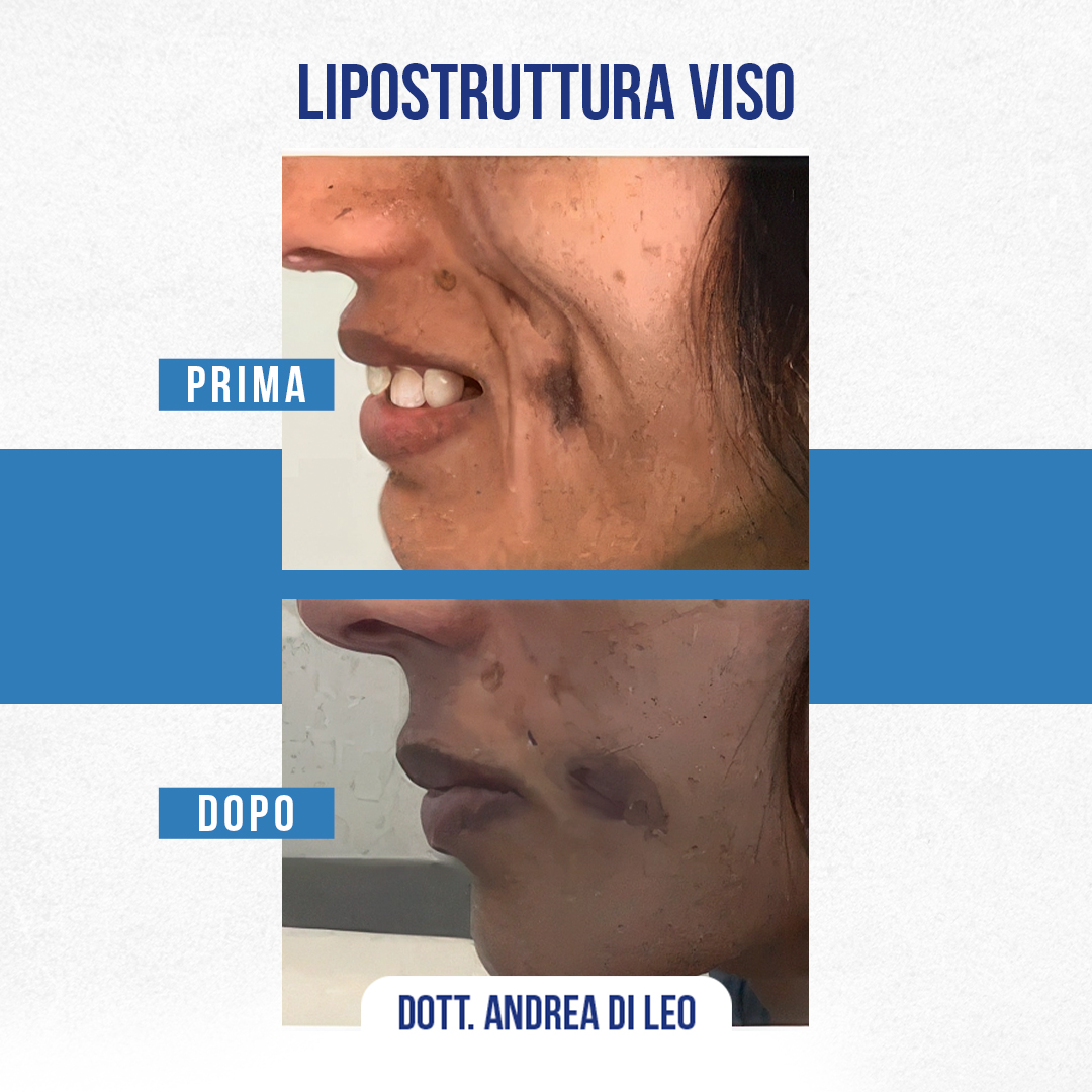 IMG-LIPOSTRUTTURA-VISO