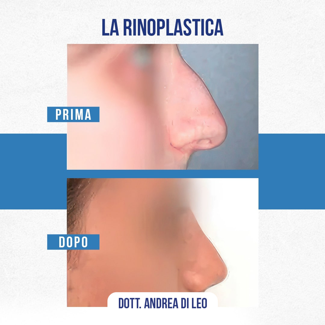 Img-Prima-Dopo-RINOPLASTICA-01