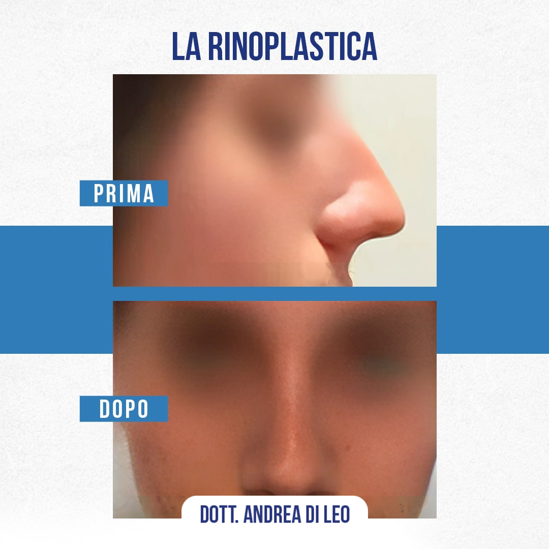 Img-Prima-Dopo-RINOPLASTICA-02