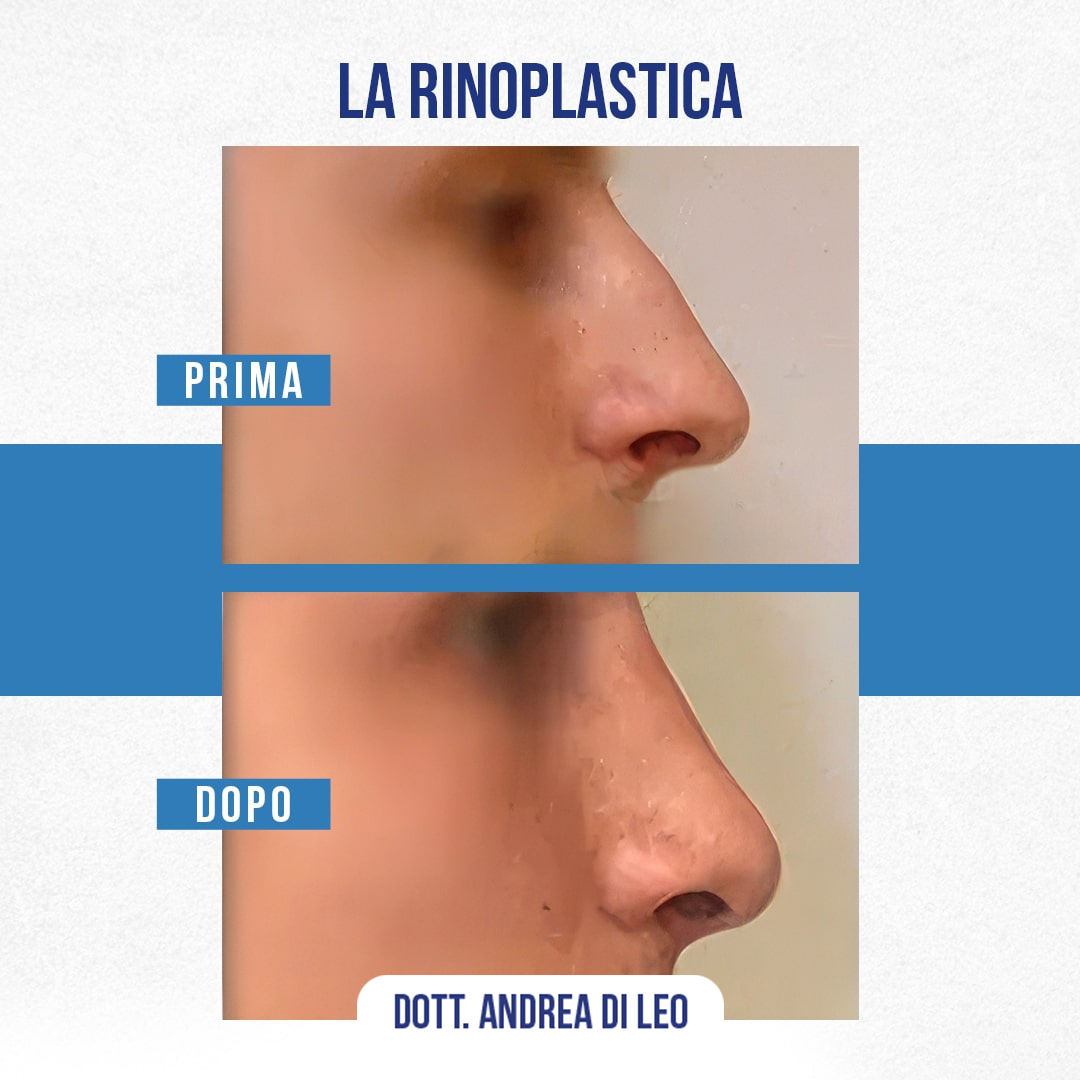 Img-Prima-Dopo-RINOPLASTICA-03