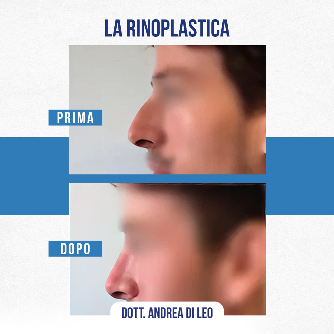 Img-Prima-Dopo-RINOPLASTICA-04