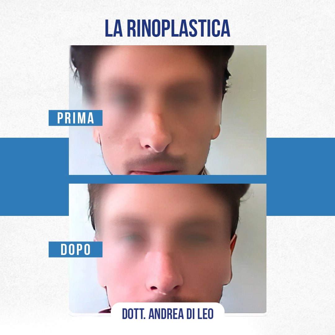 Img-Prima-Dopo-RINOPLASTICA-05