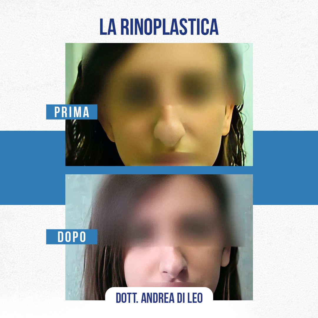 Img-Prima-Dopo-RINOPLASTICA-07