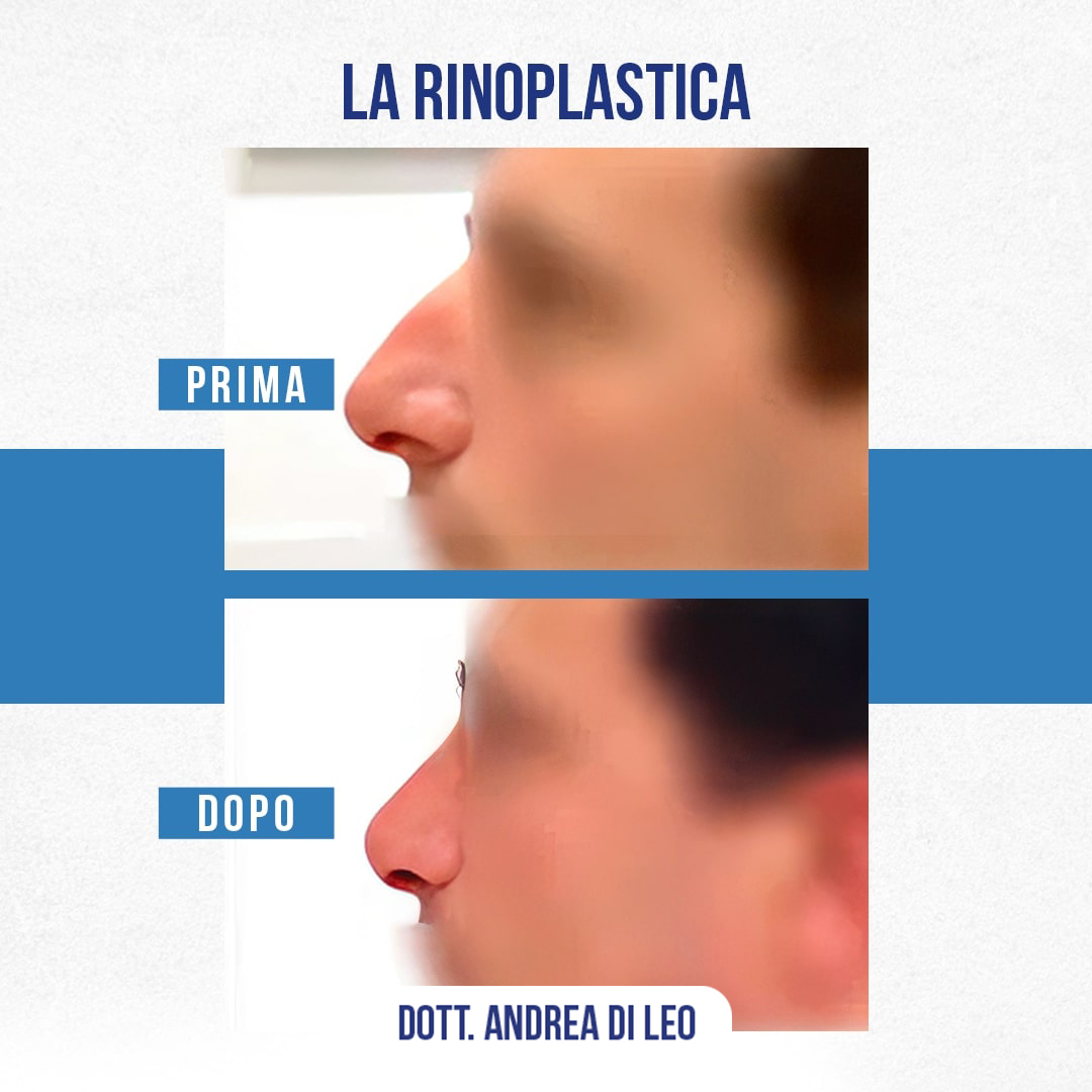 Img-Prima-Dopo-RINOPLASTICA-08