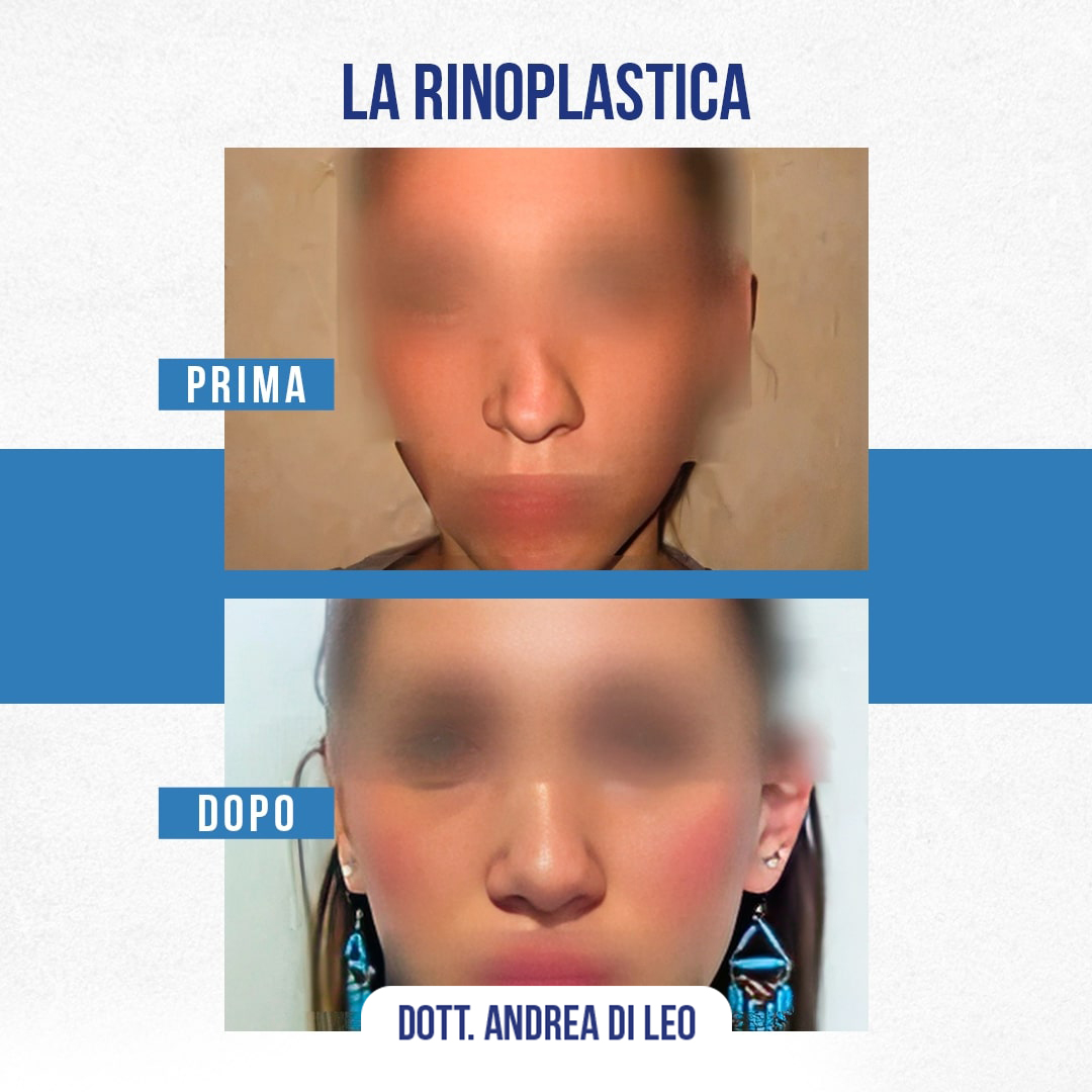 Img-Prima-Dopo-RINOPLASTICA-09