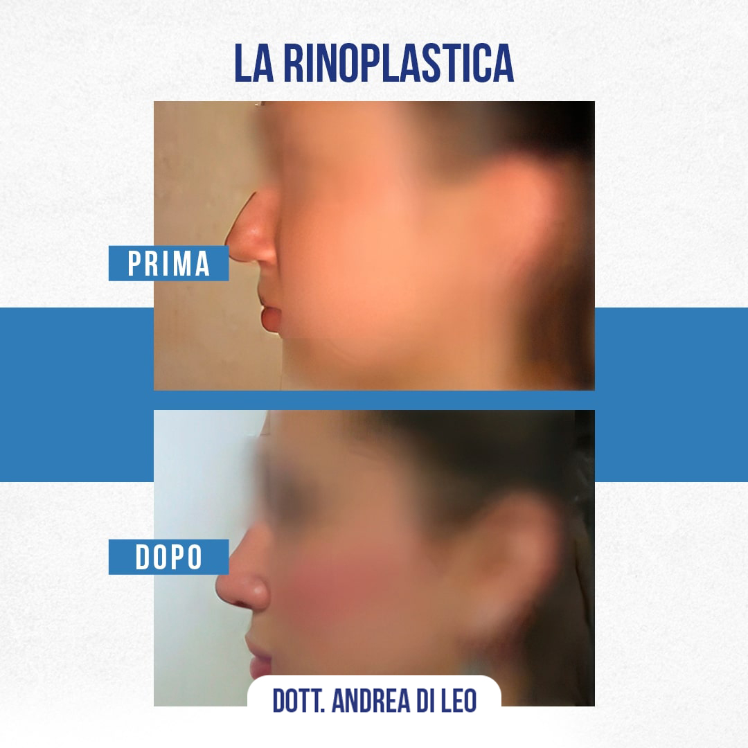 Img-Prima-Dopo-RINOPLASTICA-10