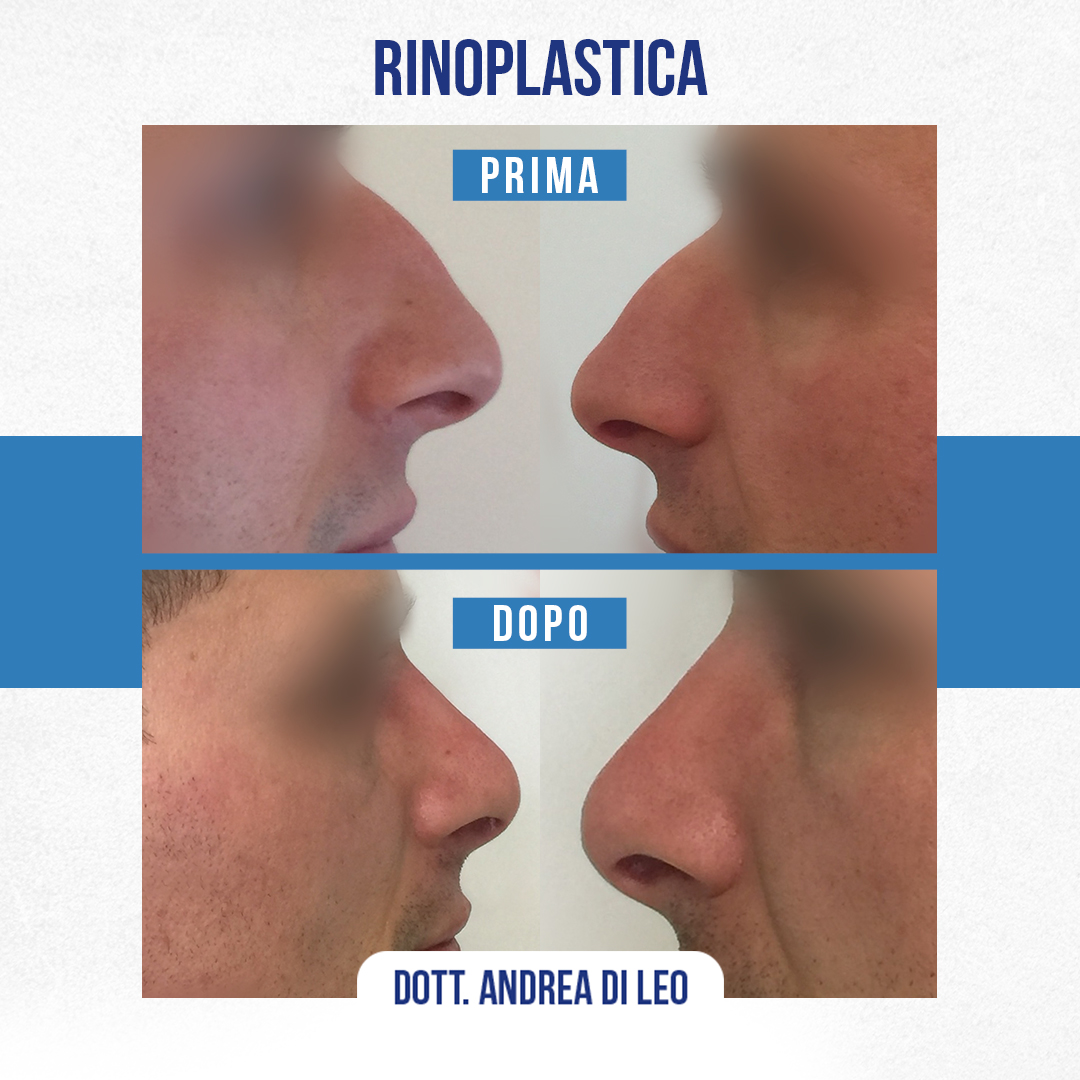 Img-Prima-Dopo-RINOPLASTICA-12