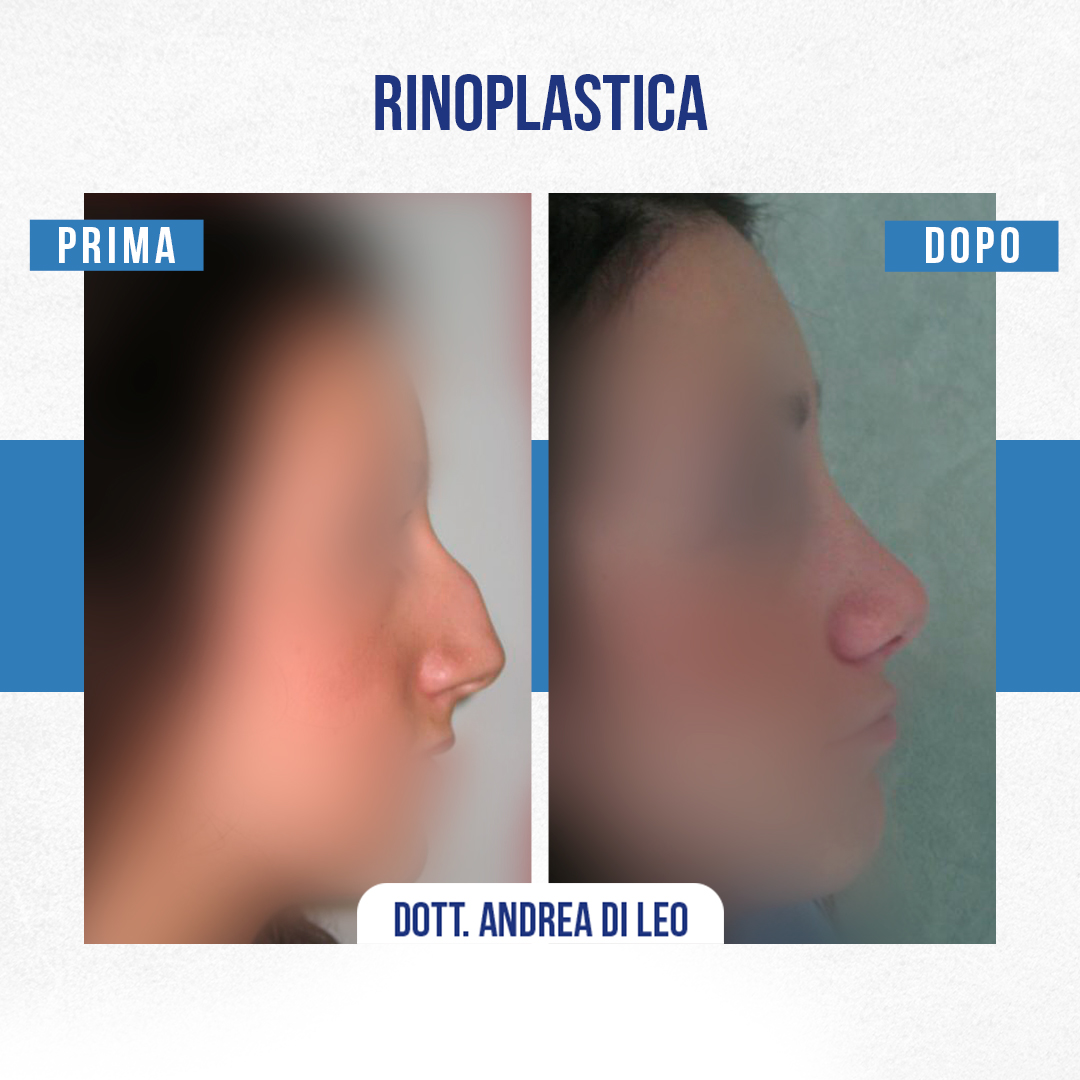 Img-Prima-Dopo-RINOPLASTICA-15