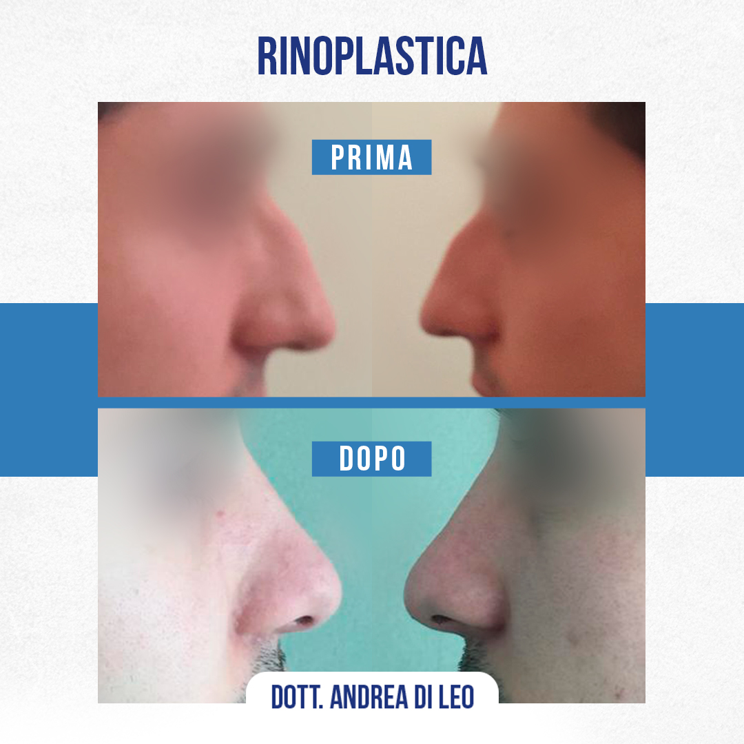 Img-Prima-Dopo-RINOPLASTICA-16