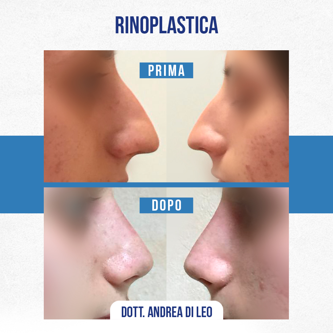 Img-Prima-Dopo-RINOPLASTICA-17