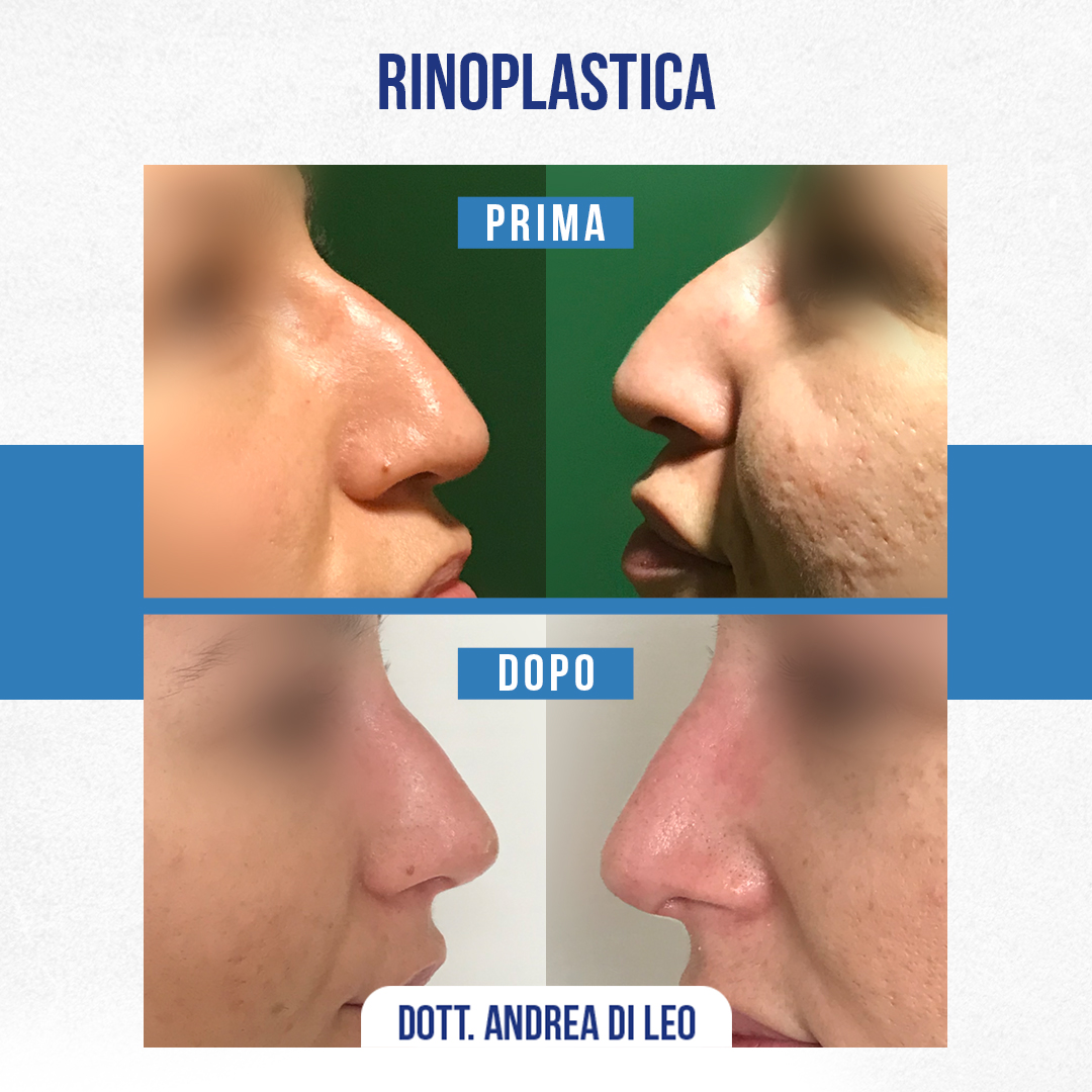 Img-Prima-Dopo-RINOPLASTICA-18