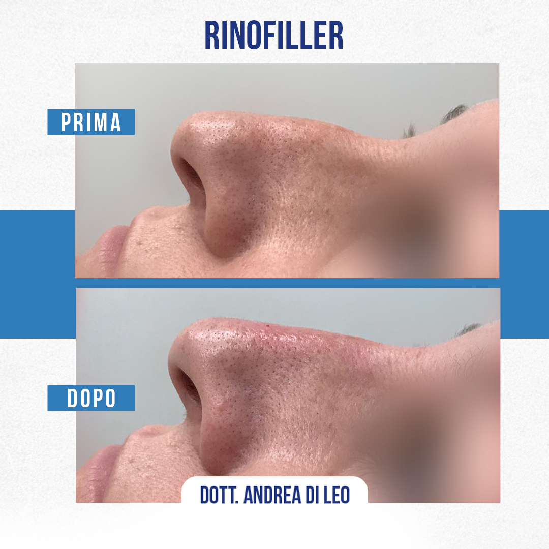 Img-Rinofiller