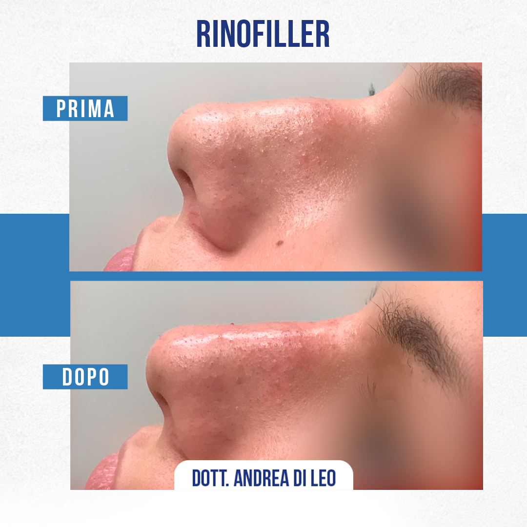 Img-Rinofiller1