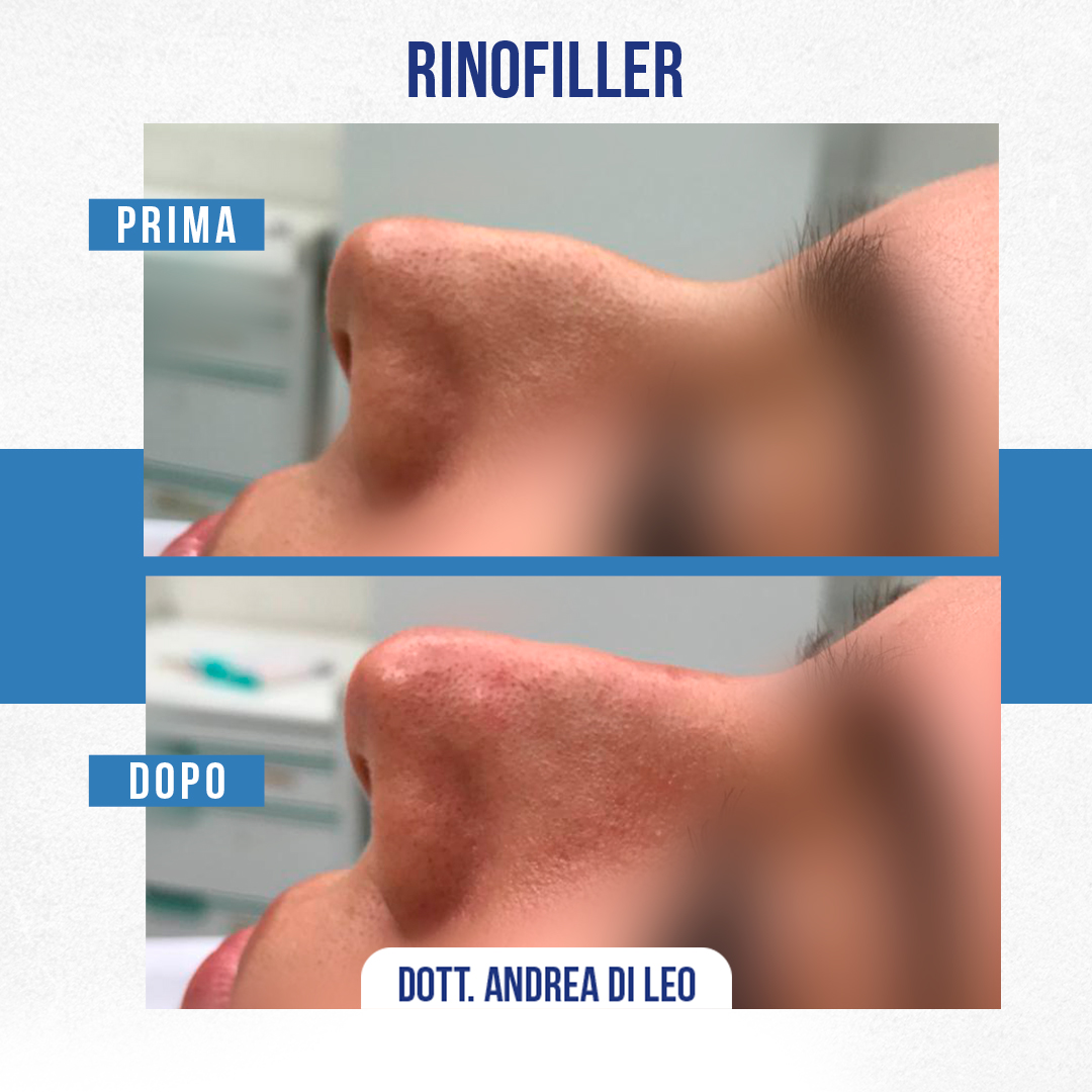 Img-Rinofiller3