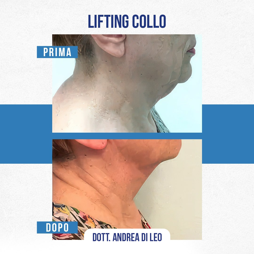 Img-prim-dop-LIFTING-COLLO-1