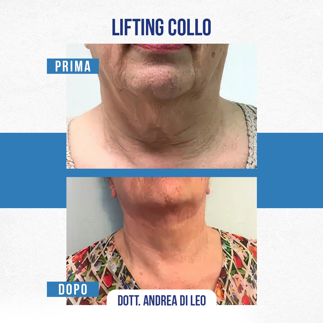 Img-prim-dop-LIFTING-COLLO-2