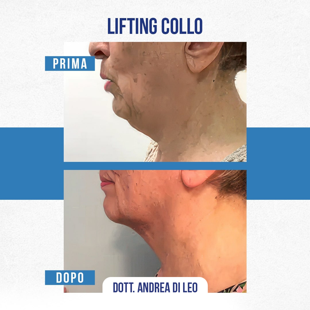 Img-prim-dop-LIFTING-COLLO-3