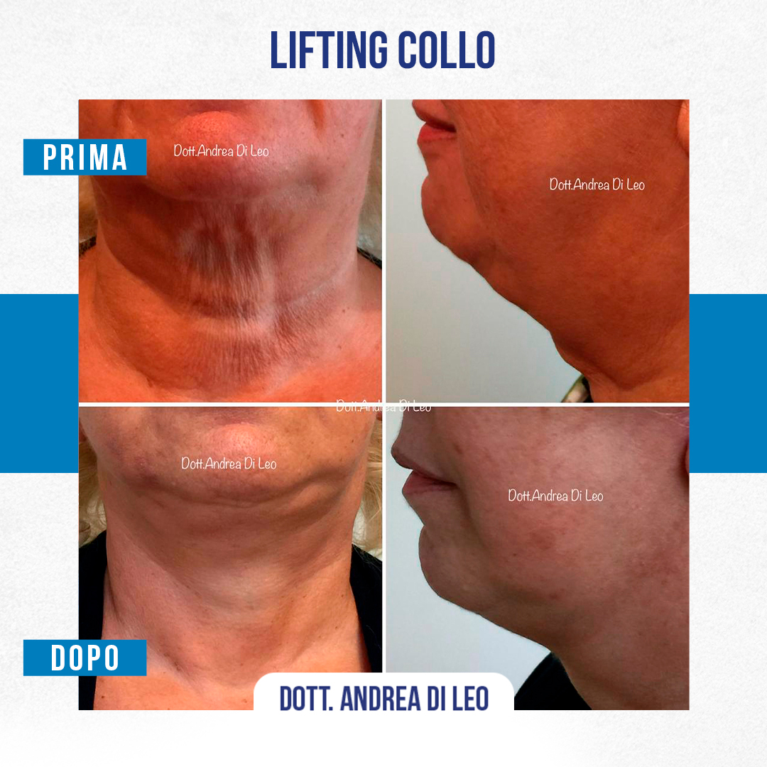 Img-prim-dop-LIFTING-COLLO-5