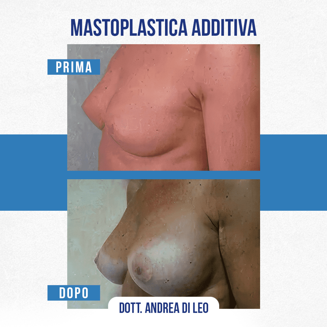 Img-prim-dop-MASTOPLASTICA-ADDITIVA-1