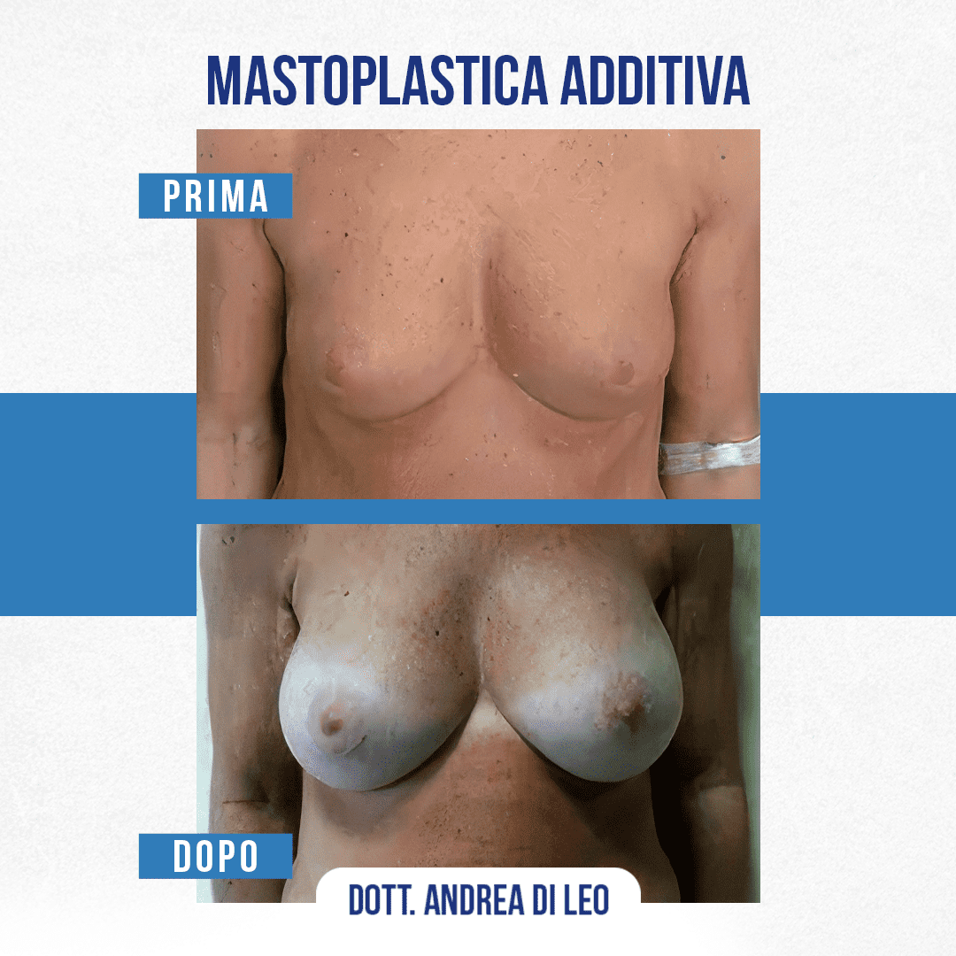 Img-prim-dop-MASTOPLASTICA-ADDITIVA-2