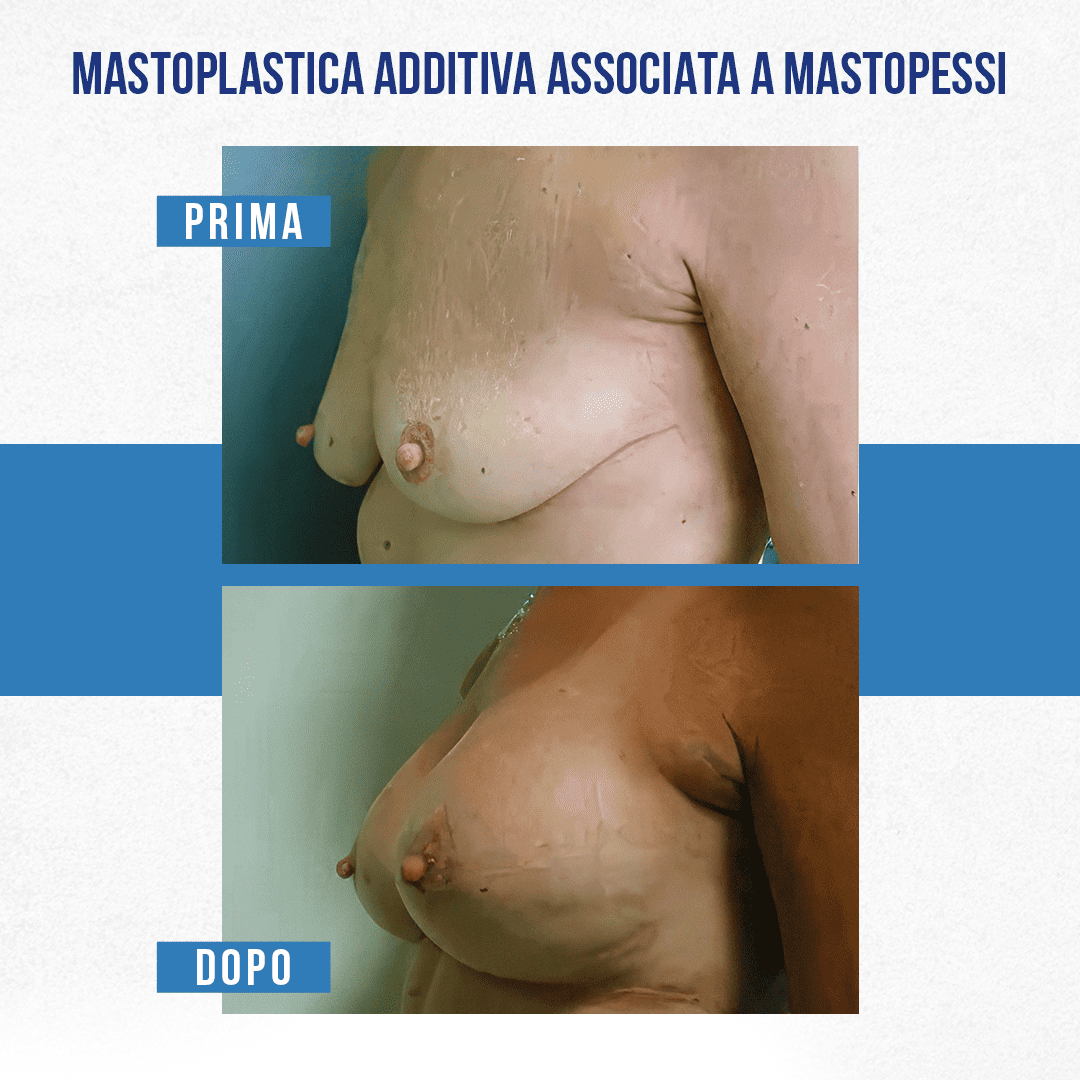 Img-prim-dop-MASTOPLASTICA ADDITIVA ASSOCIATA A MASTOPESSI-1