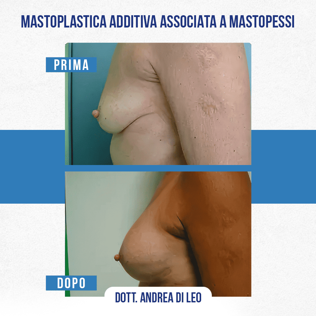 Img-prim-dop-MASTOPLASTICA ADDITIVA ASSOCIATA A MASTOPESSI-2