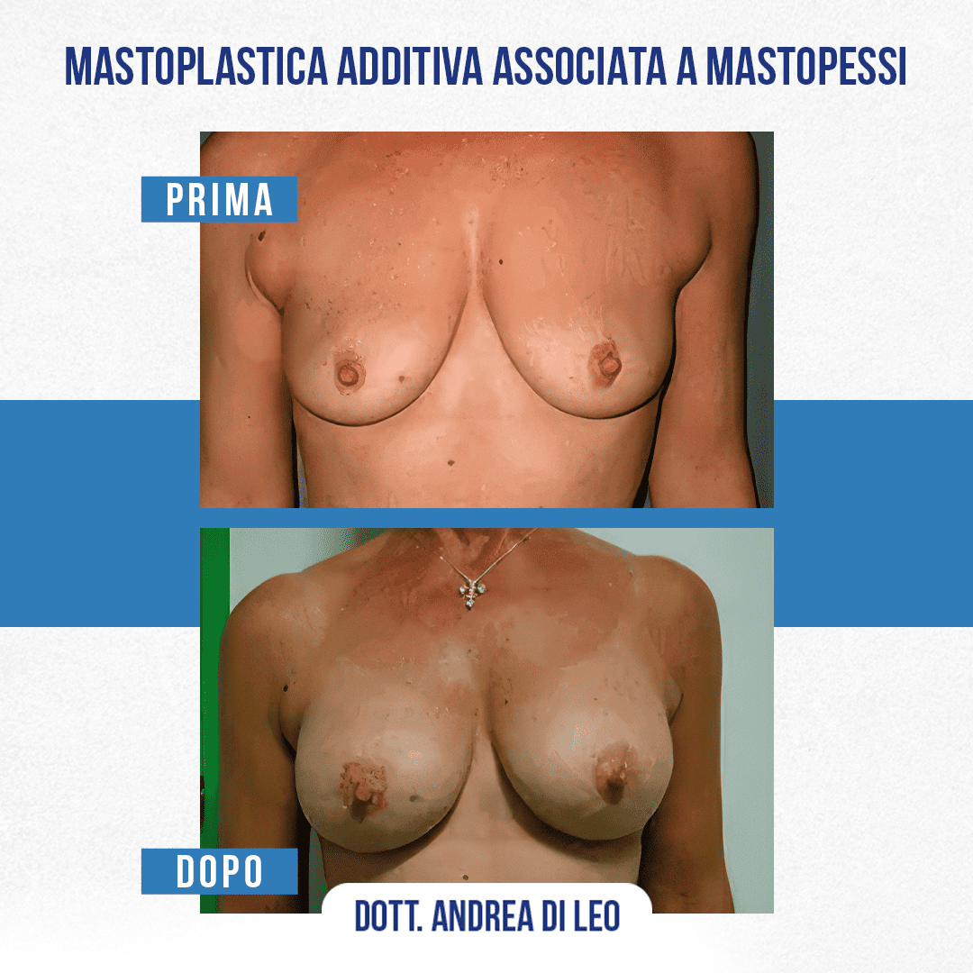 Img-prim-dop-MASTOPLASTICA ADDITIVA ASSOCIATA A MASTOPESSI-3