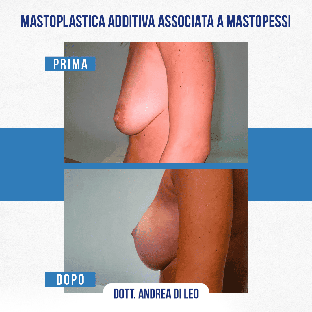 Img-prim-dop-MASTOPLASTICA ADDITIVA ASSOCIATA A MASTOPESSI-4