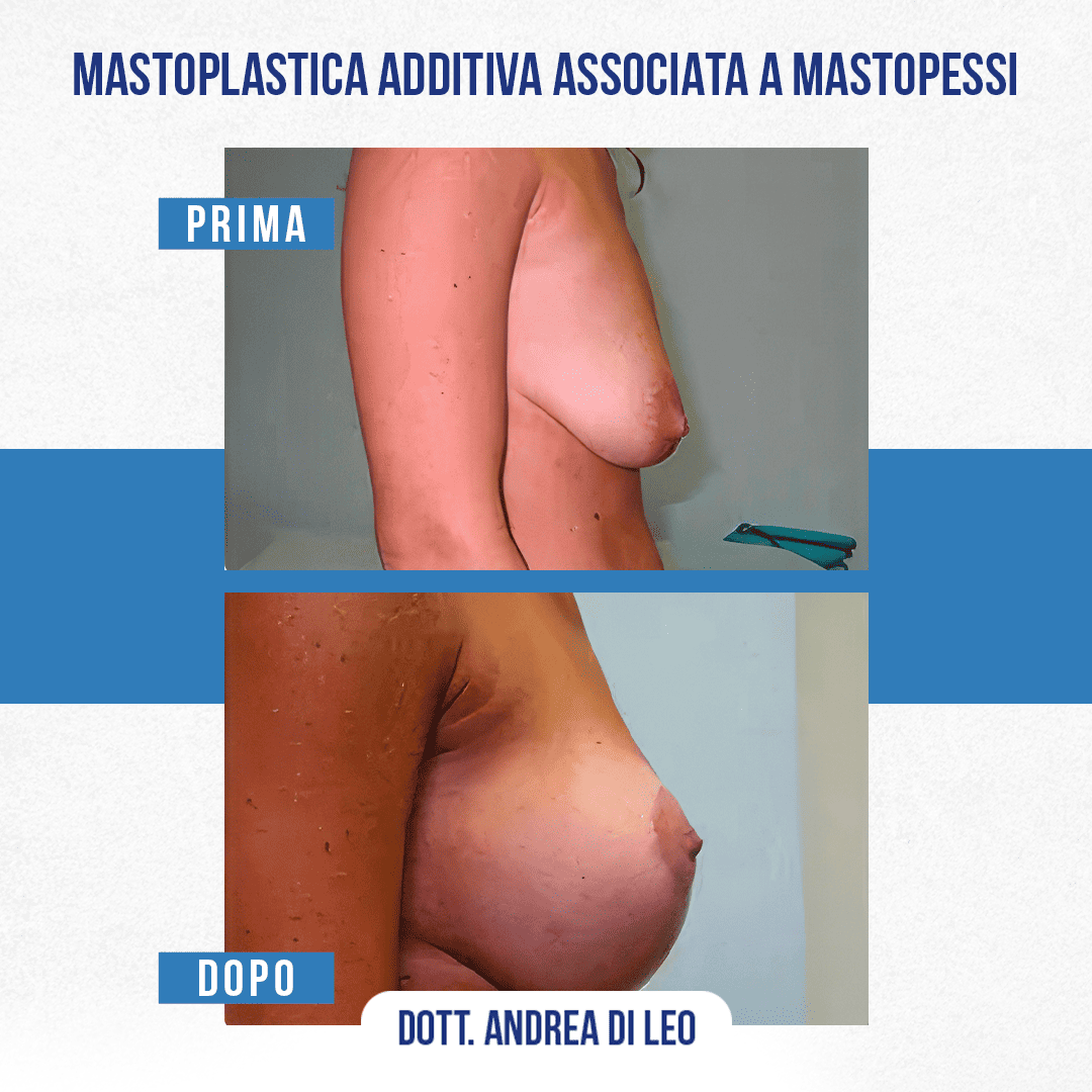 Img-prim-dop-MASTOPLASTICA ADDITIVA ASSOCIATA A MASTOPESSI-5