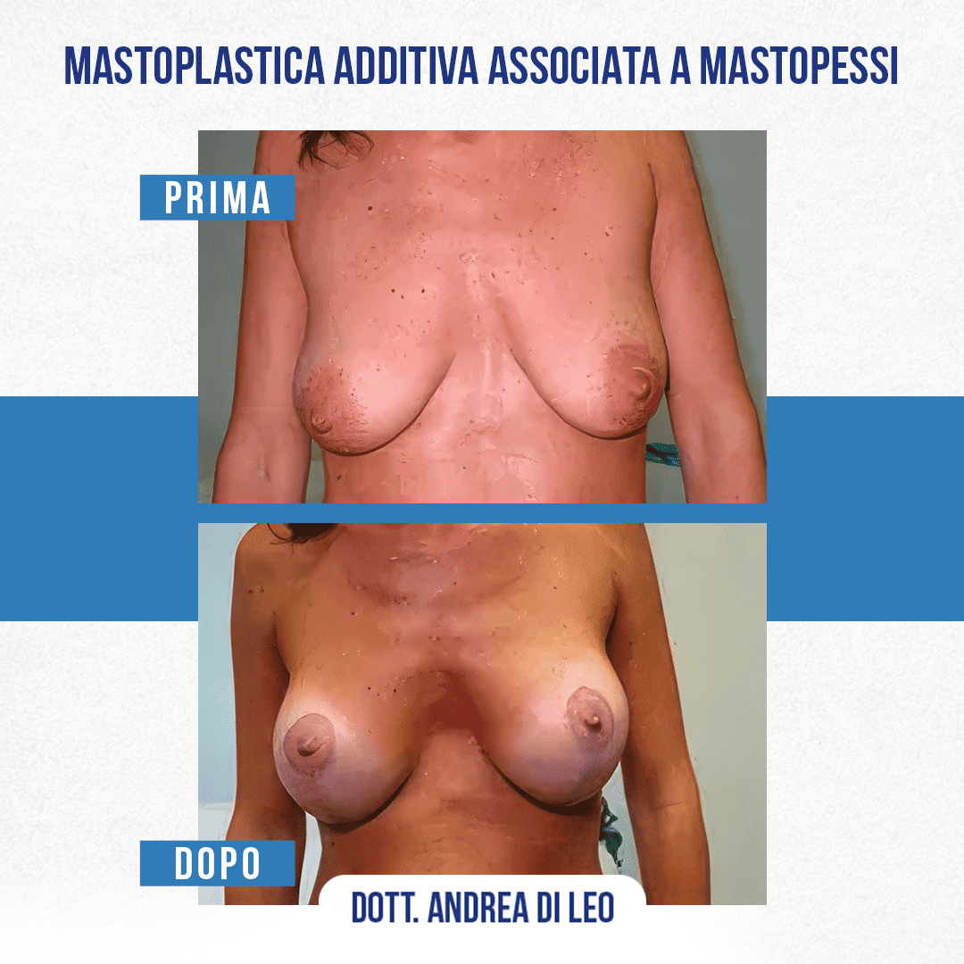 Img-prim-dop-MASTOPLASTICA ADDITIVA ASSOCIATA A MASTOPESSI-6