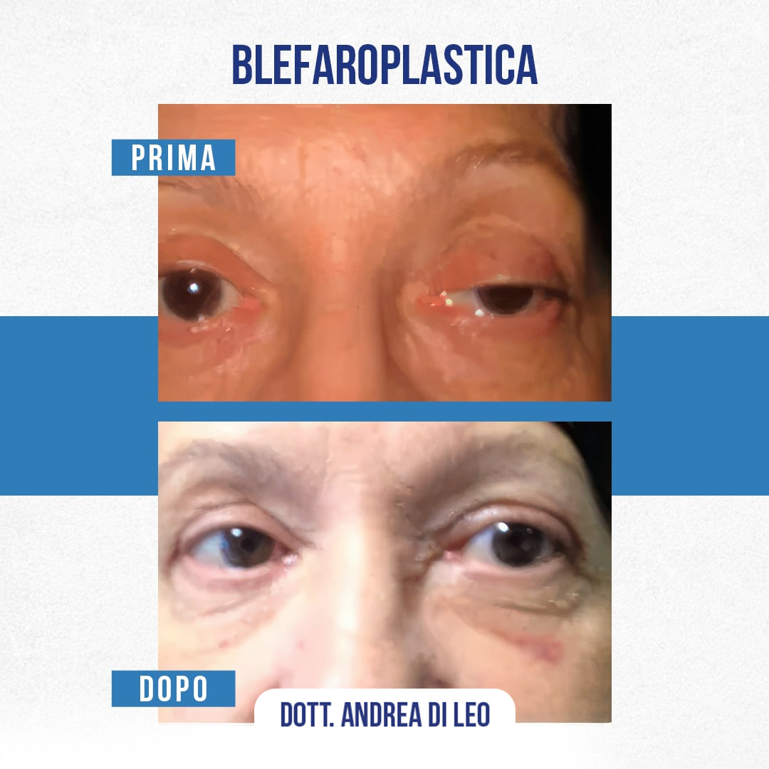 Img-prim-dop-blefaroplastica-1