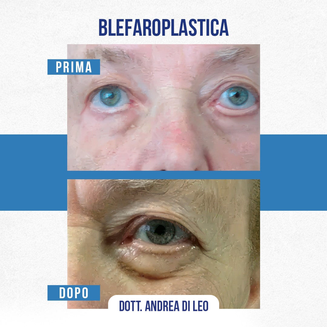 Img-prim-dop-blefaroplastica-2