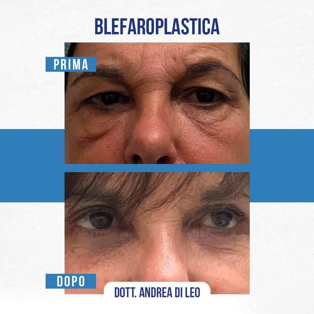 Img-prim-dop-blefaroplastica-3