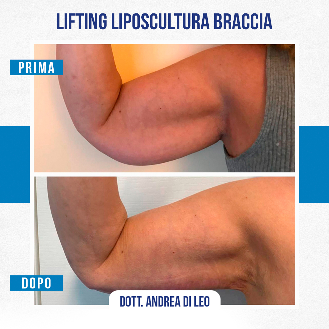 LIFTING-E-LIPOSCULTURA-BRACCIA-02