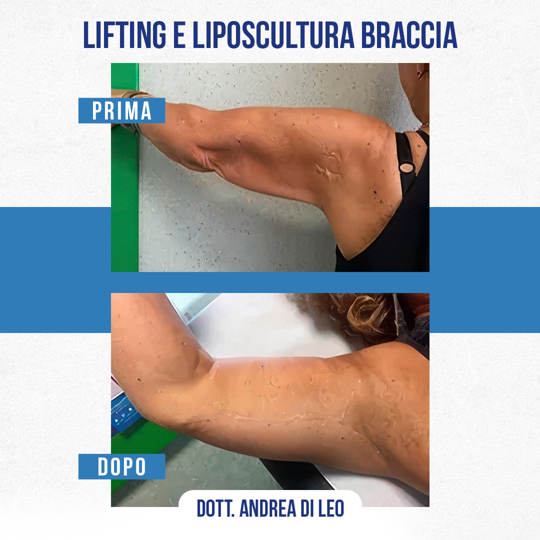 LIFTING-E-LIPOSCULTURA-BRACCIA
