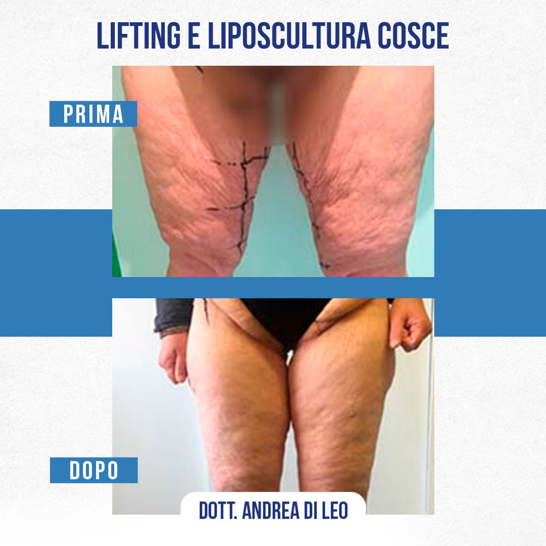 LIFTING E LIPOSCULTURA COSCE-02