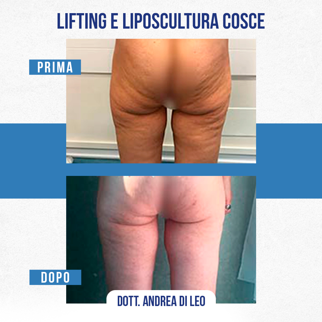 LIFTING E LIPOSCULTURA COSCE-03