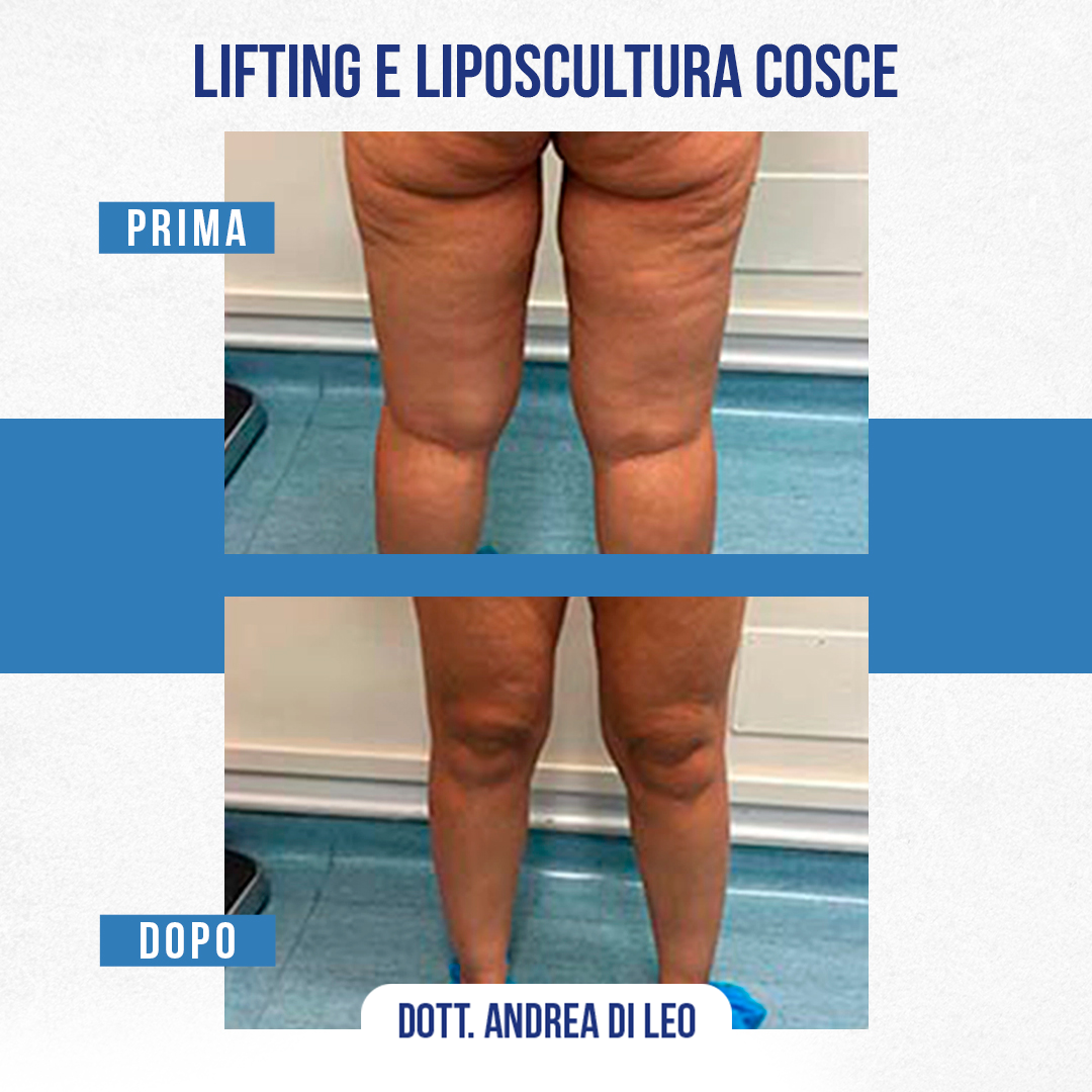 LIFTING E LIPOSCULTURA COSCE-04