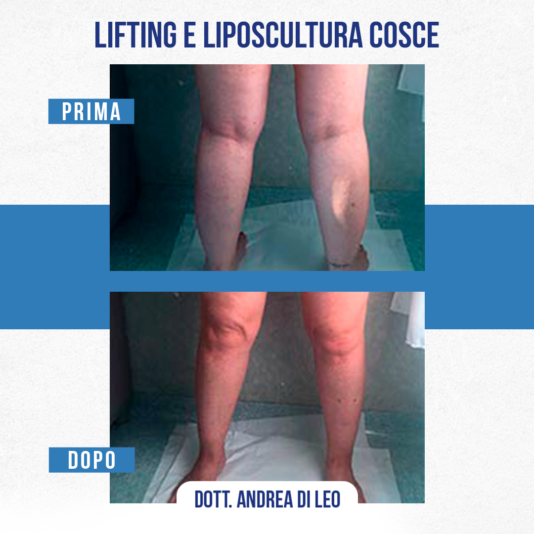 LIFTING E LIPOSCULTURA COSCE-05