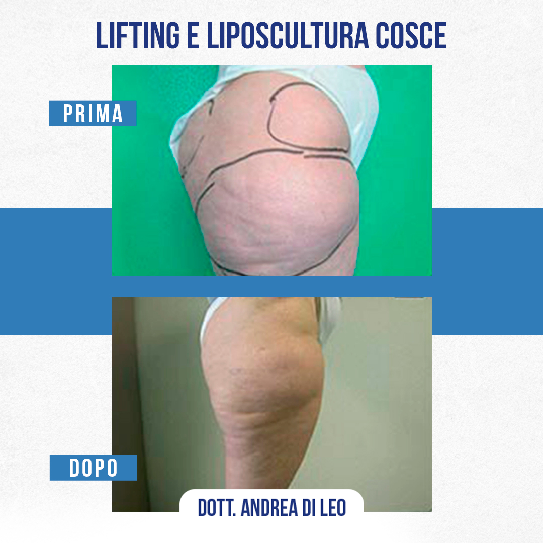 LIFTING E LIPOSCULTURA COSCE-06