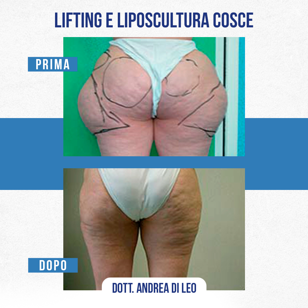 LIFTING E LIPOSCULTURA COSCE-07