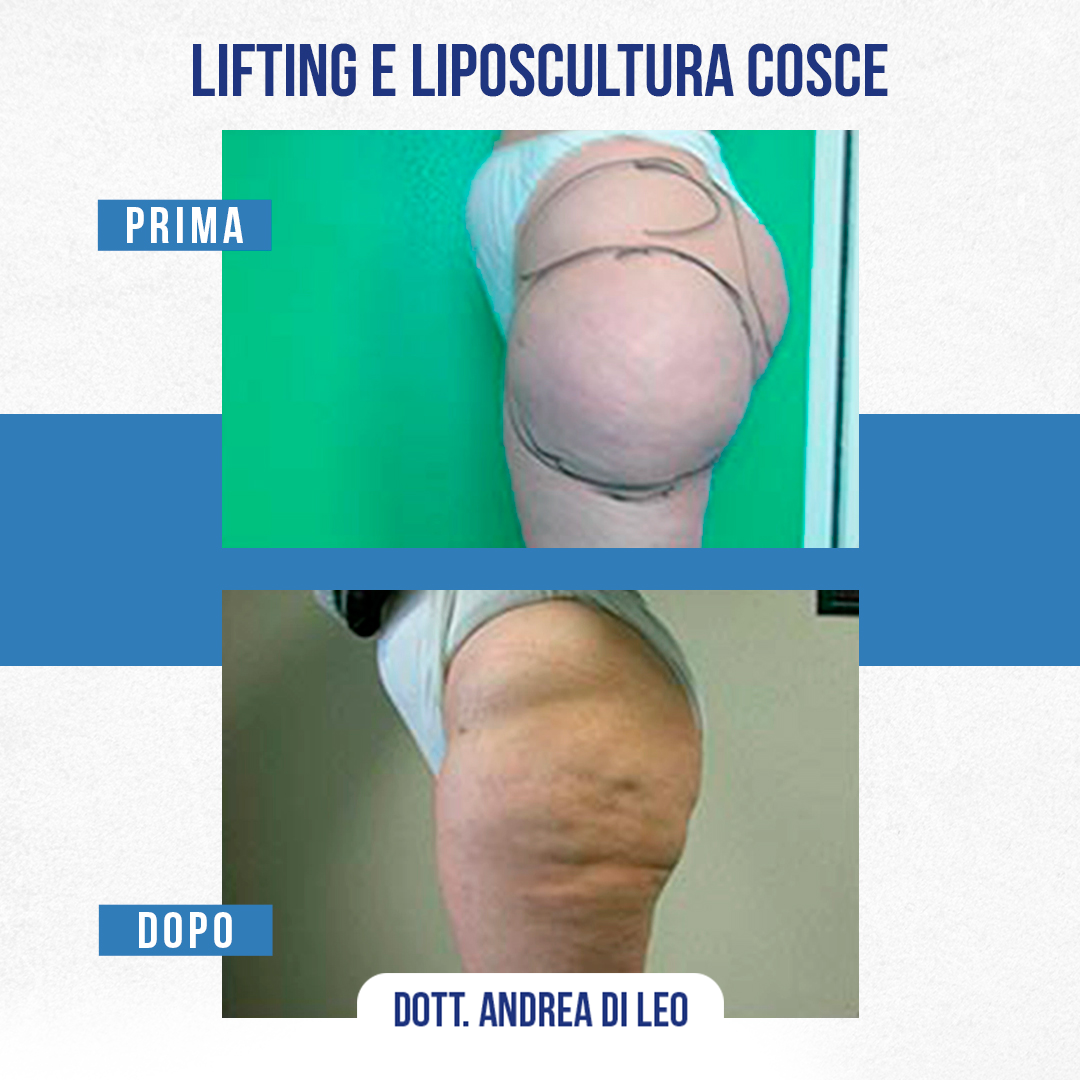 LIFTING E LIPOSCULTURA COSCE-08