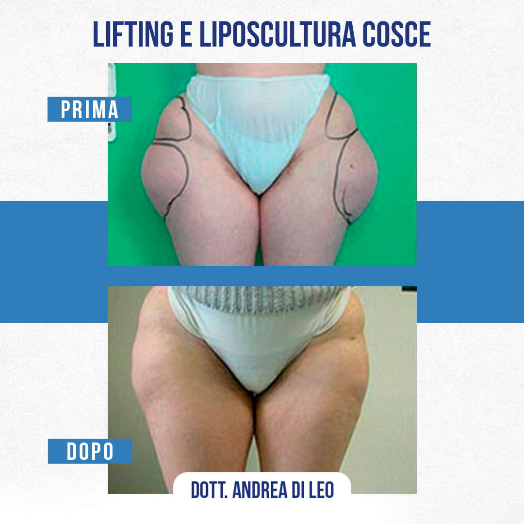 LIFTING E LIPOSCULTURA COSCE