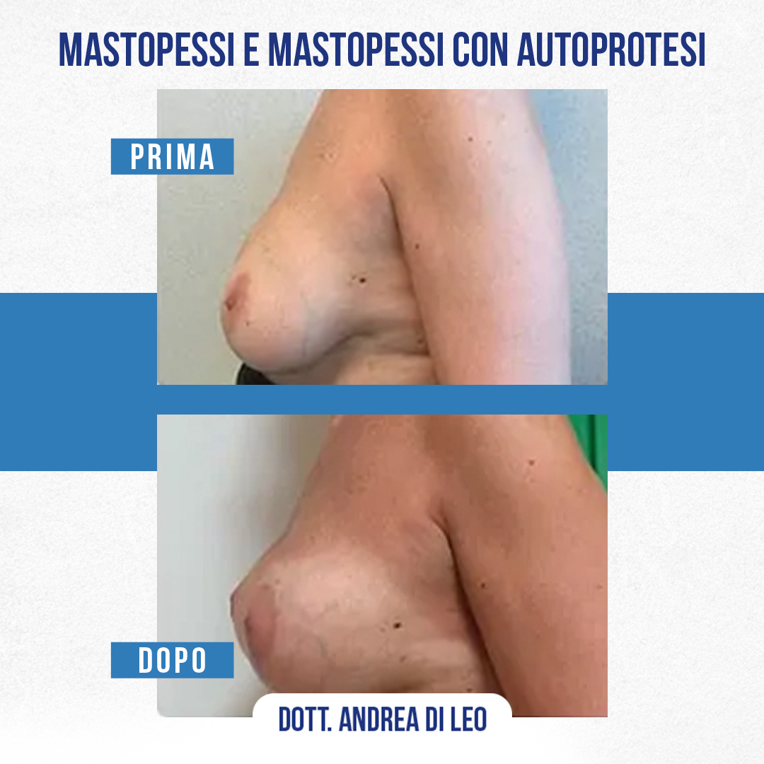 MASTOPESSI-E-MASTOPESSI-CON-AUTOPROTESI