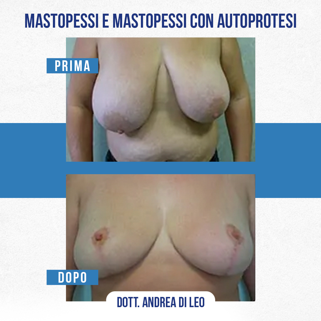 MASTOPESSI-E-MASTOPESSI-CON-AUTOPROTESI1