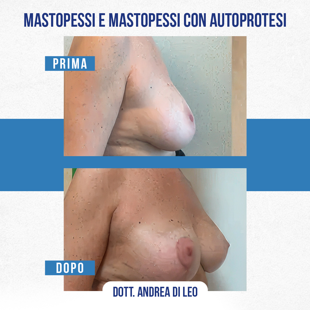 MASTOPESSI-E-MASTOPESSI-CON-AUTOPROTESI2