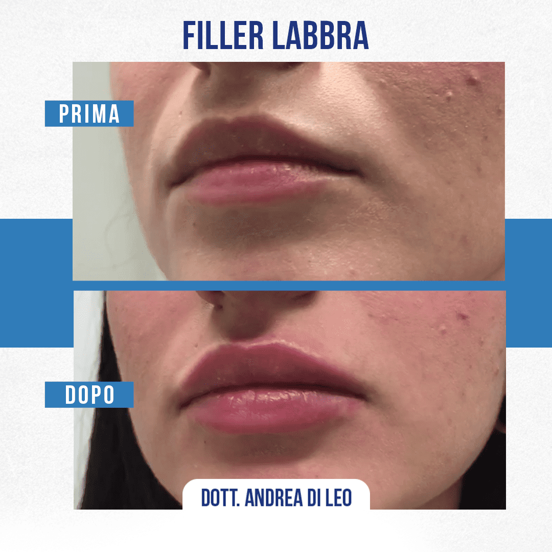 img-Filler-Labbra-DiLeo-1